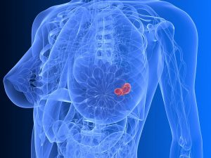 Carcinome mammaire