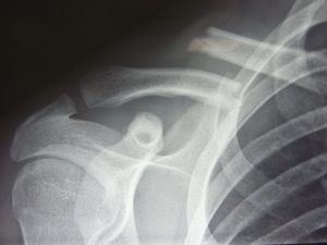 Fracture de la clavicule