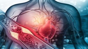 Hypertension-arterielle-essentielle