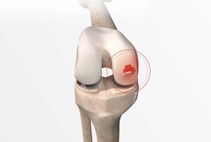 Lésion du cartilage du genou