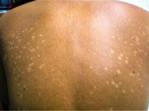 Pityriasis versicolor