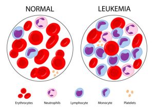 Leucémie lymphoïde